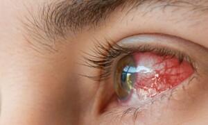 پشاور: سیلابی صورتحال کے باعث آشوب چشم کی وبا پھوٹ پڑی