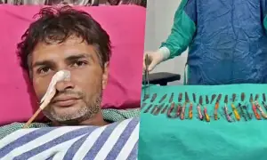 مریض کے پیٹ سے 29 چمچ، 19 ٹوتھ برش اور 2 پین نکال لیے گئے
