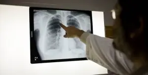 Over 140 Pakistanis die every day from TB, says WHO