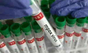 Young man tests positive for mpox in Karachi