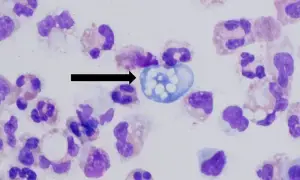 Man with no history of swimming dies of brain infection caused by Naegleria fowleri in Karachi