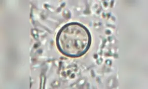What to know about the US outbreak of cyclospora parasite intestinal illness