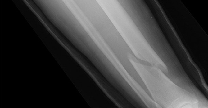 broken leg-670